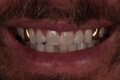 Patient Smile Before & After Gallery - Patient 260693 - Image 1