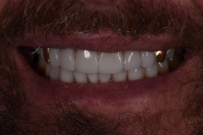 Patient Smile Before & After Gallery - Patient 260693 - Image 2