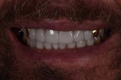 Patient Smile Before & After Gallery - Patient 260693 - Image 2