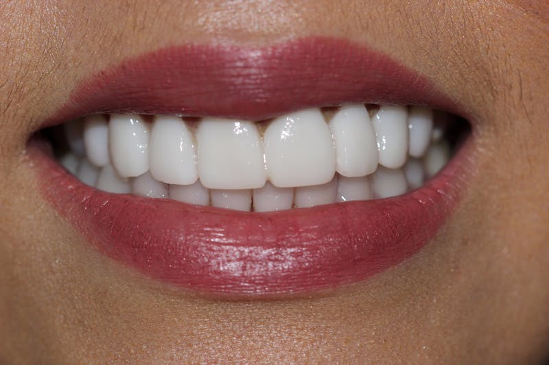 Patient Smile Before & After Gallery - Patient 135995 - Image 1