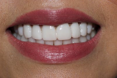 Patient Smile Before & After Gallery - Patient 135995 - Image 1