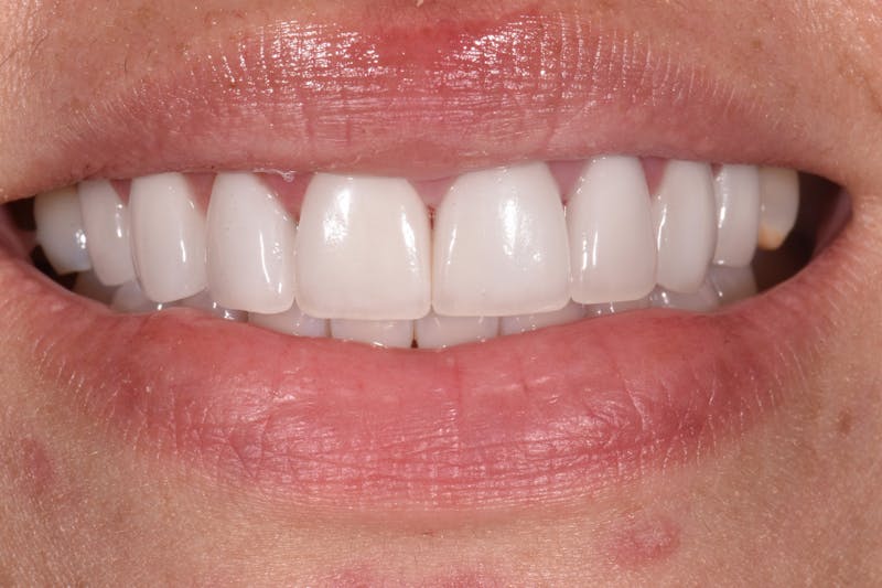 Patient Smile Before & After Gallery - Patient 135995 - Image 2