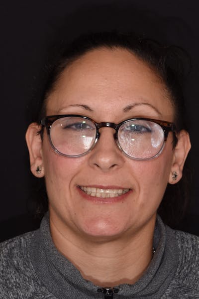 Patient Smile Before & After Gallery - Patient 406360 - Image 1