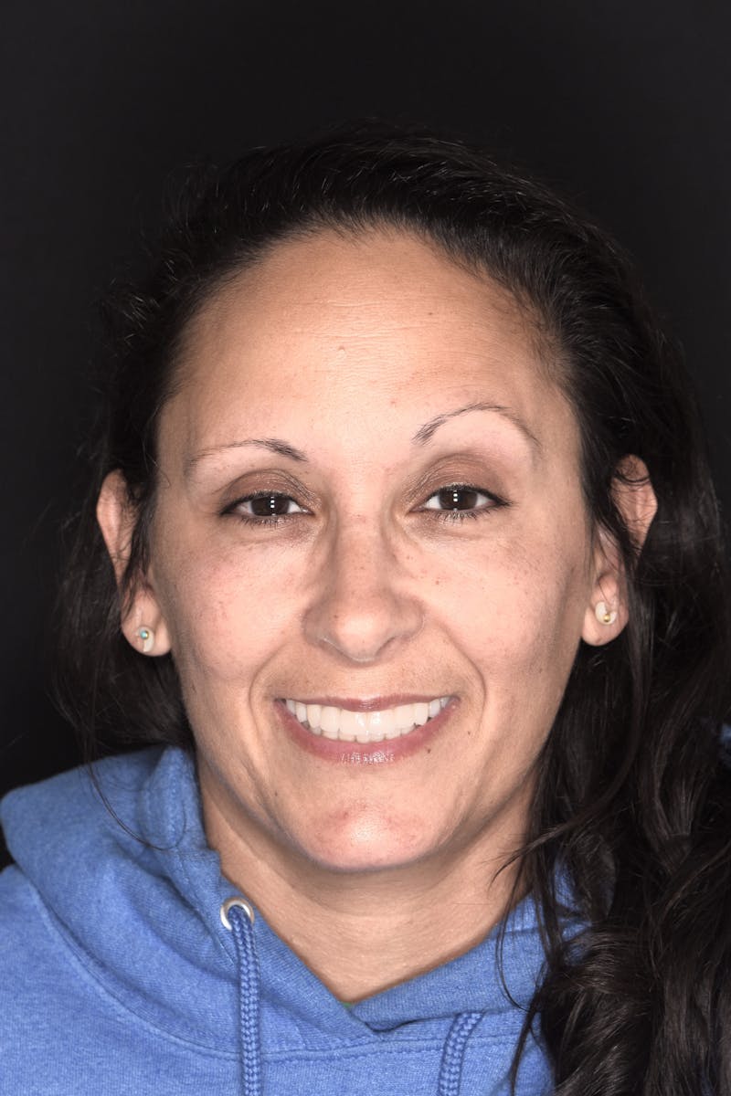 Patient Smile Before & After Gallery - Patient 406360 - Image 2