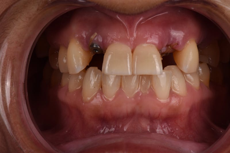 Patient Smile Before & After Gallery - Patient 406360 - Image 5