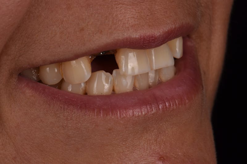 Patient Smile Before & After Gallery - Patient 406360 - Image 7