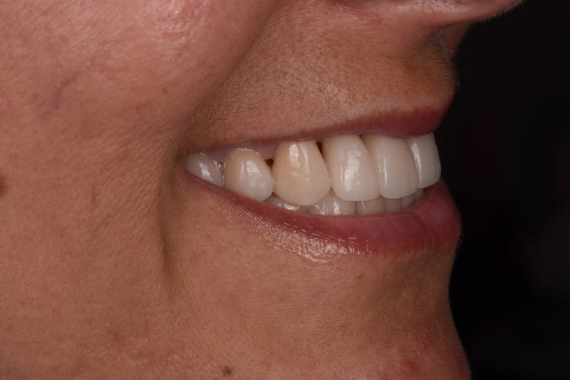 Patient Smile Before & After Gallery - Patient 406360 - Image 8