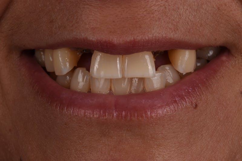Patient Smile Before & After Gallery - Patient 406360 - Image 9