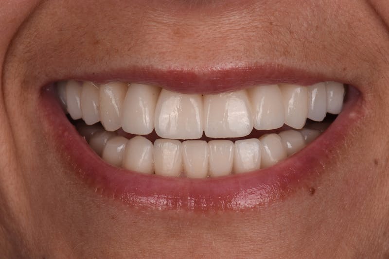 Patient Smile Before & After Gallery - Patient 406360 - Image 10