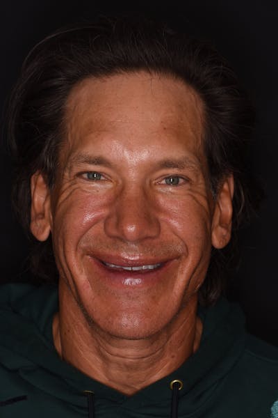 Patient Smile Before & After Gallery - Patient 371657 - Image 1