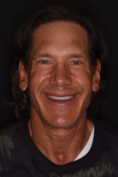 Patient Smile Before & After Gallery - Patient 371657 - Image 2