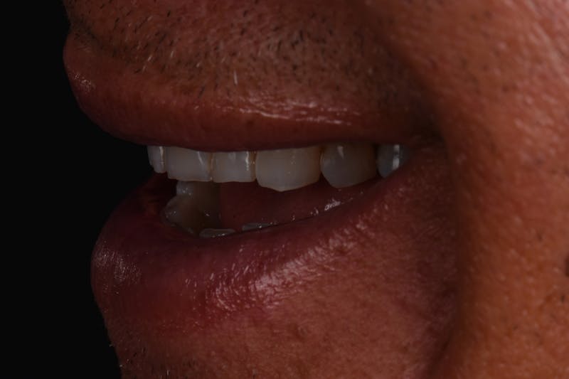 Patient Smile Before & After Gallery - Patient 371657 - Image 3