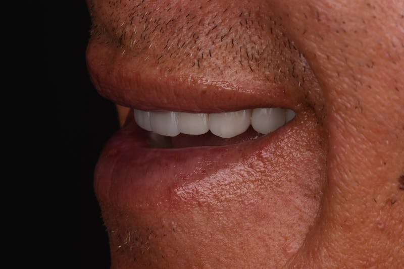 Patient Smile Before & After Gallery - Patient 371657 - Image 4