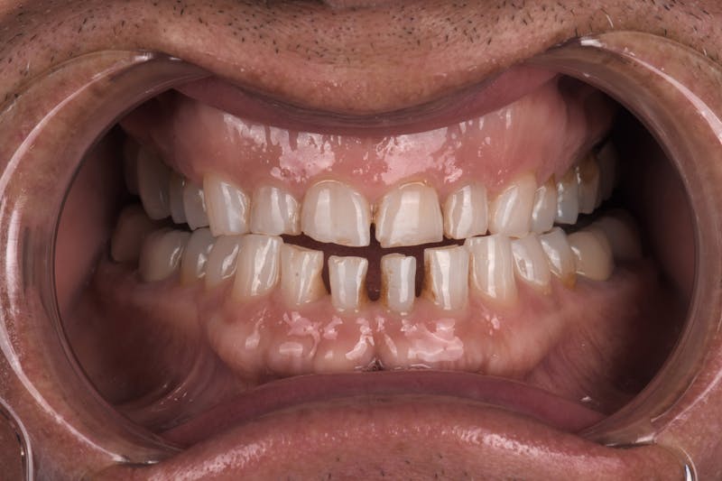 Patient Smile Before & After Gallery - Patient 371657 - Image 5