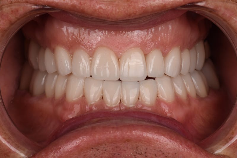Patient Smile Before & After Gallery - Patient 371657 - Image 6
