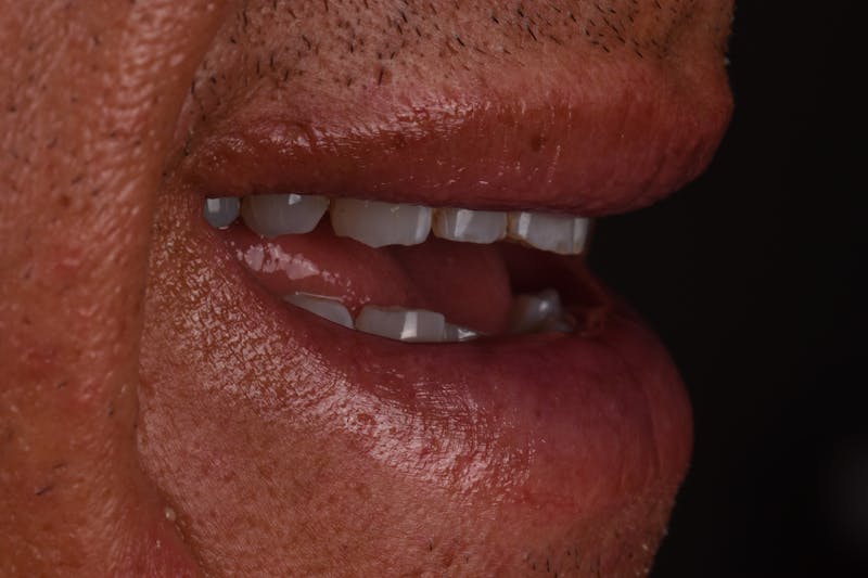 Patient Smile Before & After Gallery - Patient 371657 - Image 7