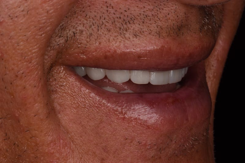 Patient Smile Before & After Gallery - Patient 371657 - Image 8