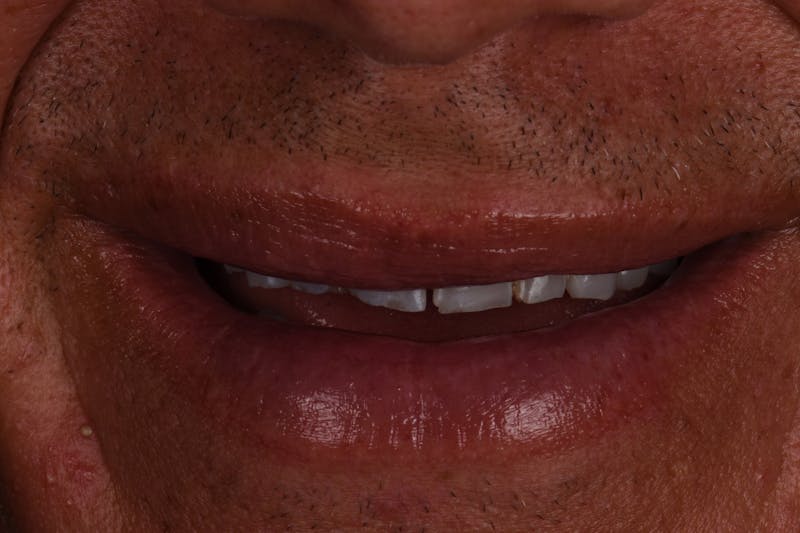 Patient Smile Before & After Gallery - Patient 371657 - Image 9