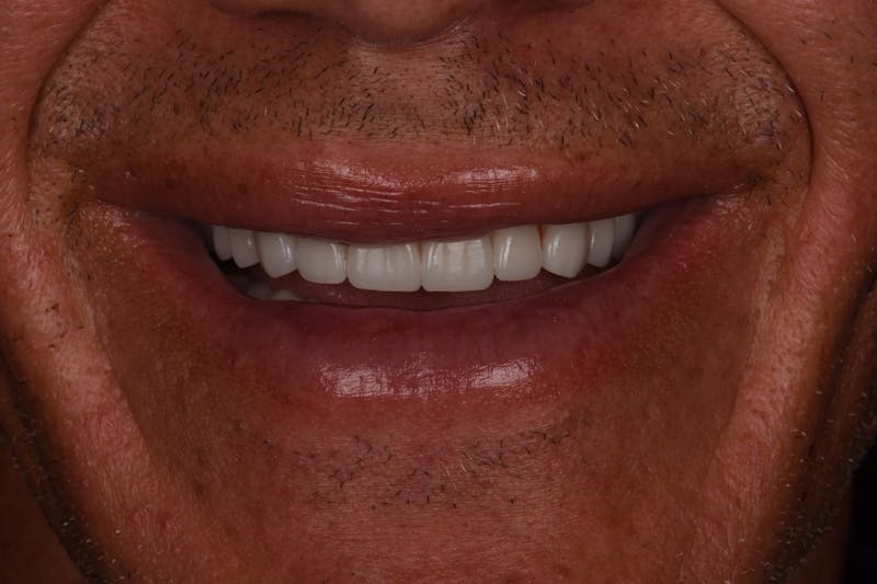 Patient Smile Before & After Gallery - Patient 371657 - Image 10