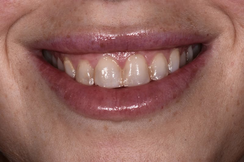 Patient Smile Before & After Gallery - Patient 124550 - Image 1
