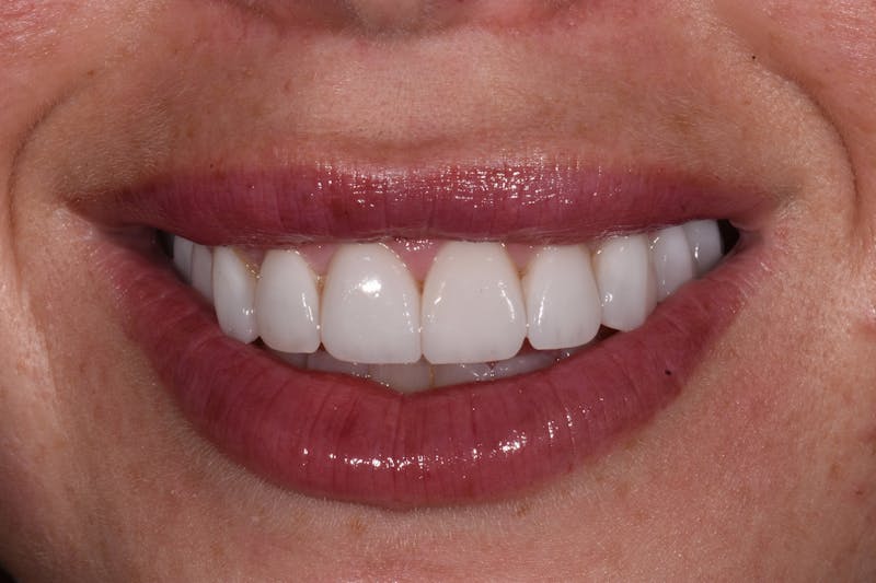 Patient Smile Before & After Gallery - Patient 124550 - Image 2