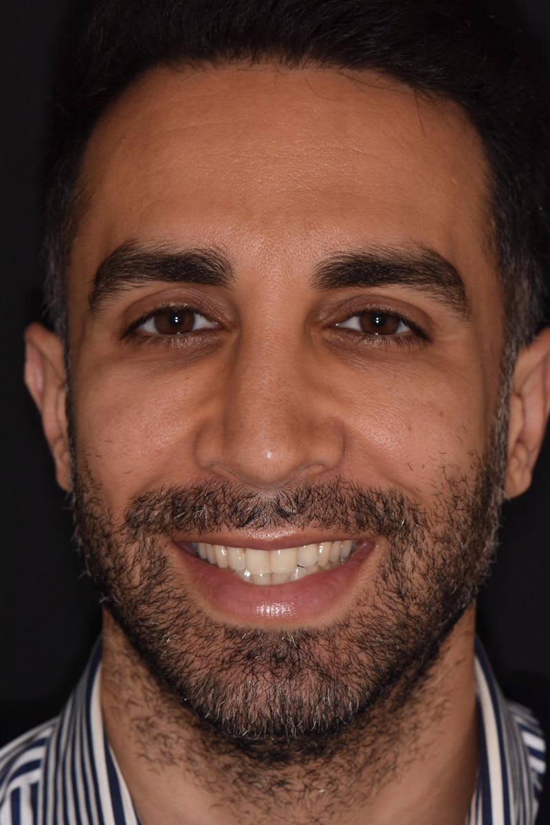 Patient Smile Before & After Gallery - Patient 242566 - Image 1