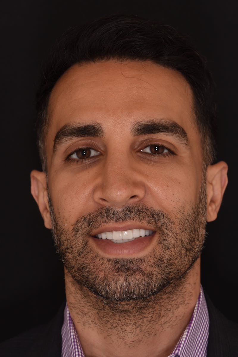 Patient Smile Before & After Gallery - Patient 242566 - Image 2