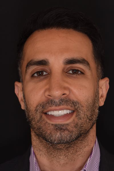 Patient Smile Before & After Gallery - Patient 242566 - Image 2