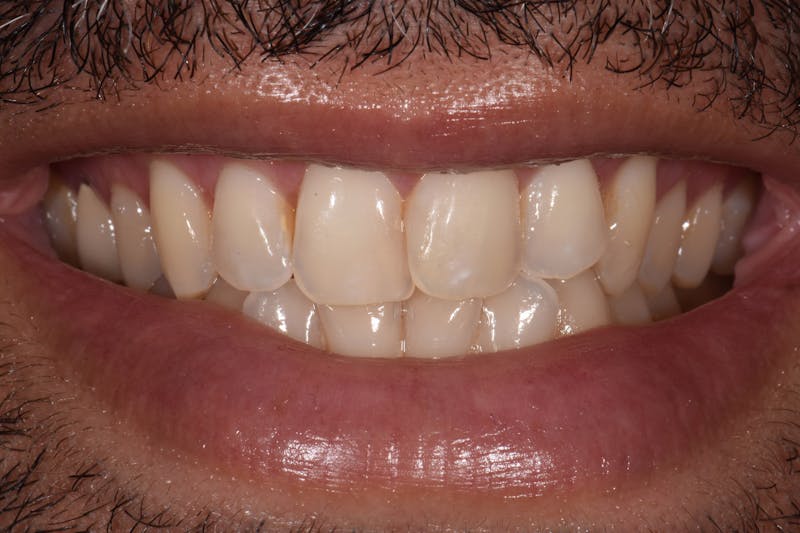 Patient Smile Before & After Gallery - Patient 242566 - Image 3