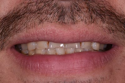 Patient Smile Before & After Gallery - Patient 382436 - Image 1