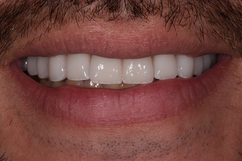 Patient Smile Before & After Gallery - Patient 382436 - Image 2