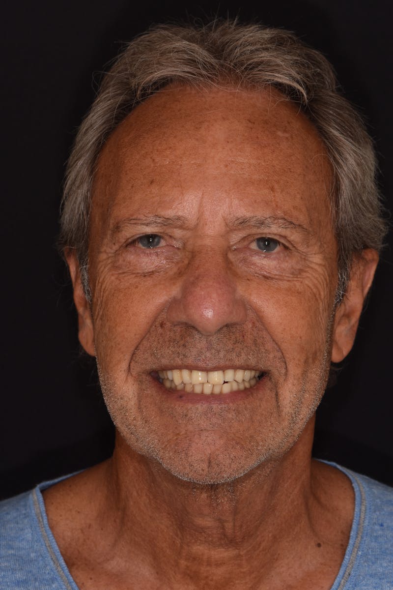 Patient Smile Before & After Gallery - Patient 103421 - Image 1