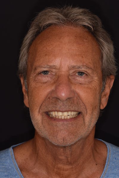 Patient Smile Before & After Gallery - Patient 103421 - Image 1