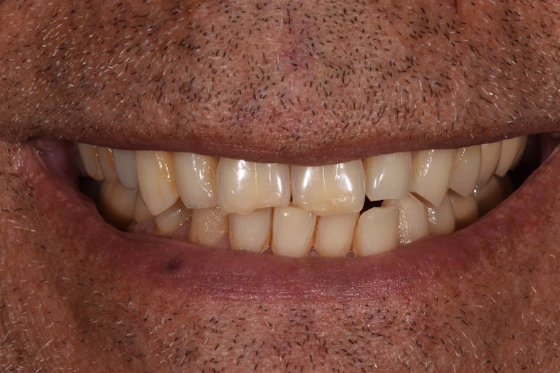 Patient Smile Before & After Gallery - Patient 103421 - Image 3