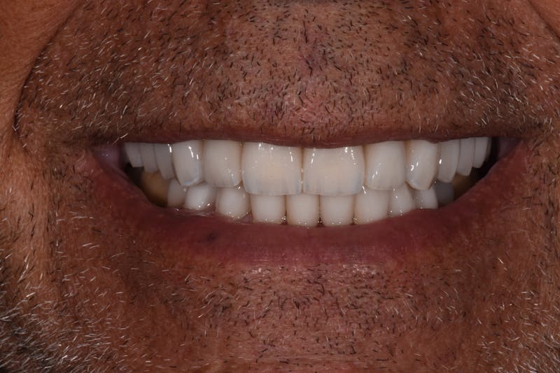 Patient Smile Before & After Gallery - Patient 103421 - Image 4