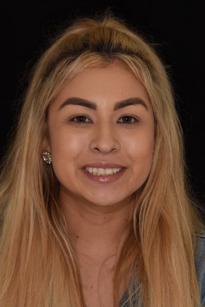 Patient Smile Before & After Gallery - Patient 594672 - Image 1