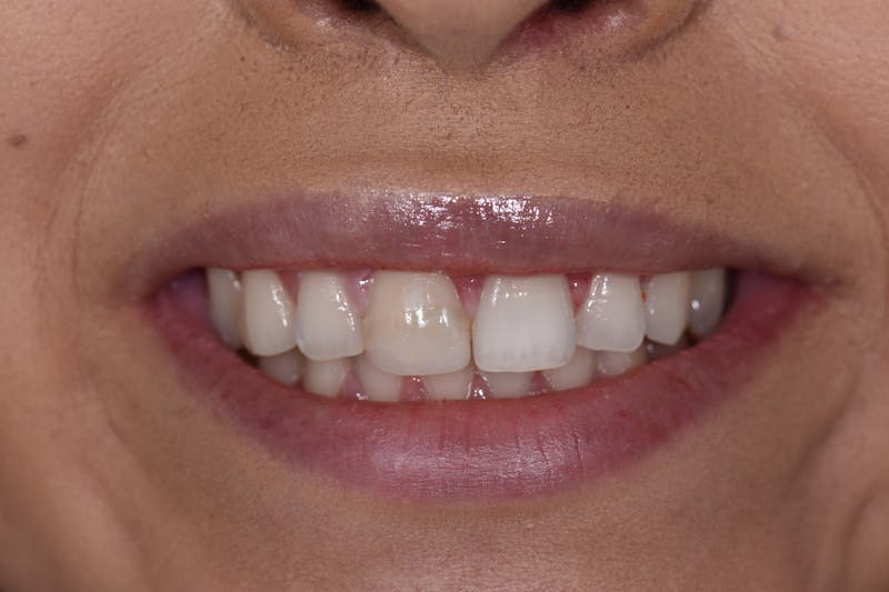 Patient Smile Before & After Gallery - Patient 594672 - Image 3