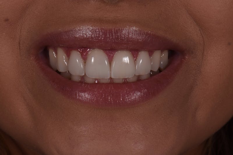 Patient Smile Before & After Gallery - Patient 594672 - Image 4