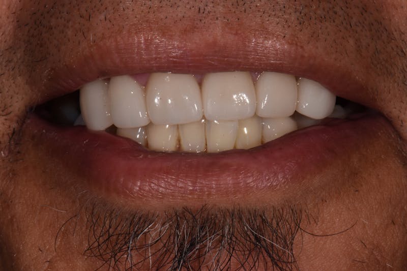 Patient Smile Before & After Gallery - Patient 424952 - Image 1