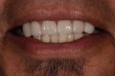 Patient Smile Before & After Gallery - Patient 424952 - Image 1
