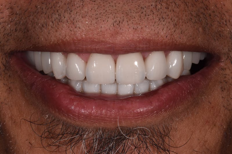 Patient Smile Before & After Gallery - Patient 424952 - Image 2