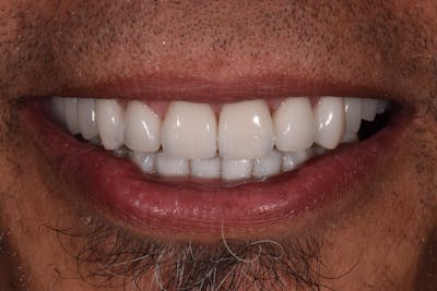 Patient Smile Before & After Gallery - Patient 424952 - Image 2