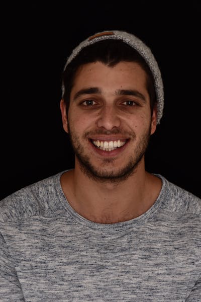 Patient Smile Before & After Gallery - Patient 172806 - Image 1