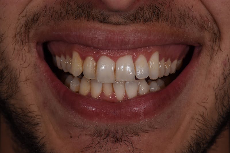 Patient Smile Before & After Gallery - Patient 172806 - Image 3