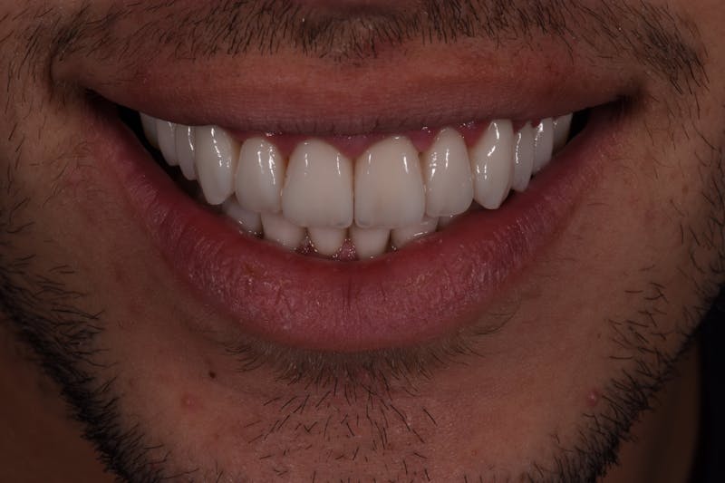 Patient Smile Before & After Gallery - Patient 172806 - Image 4