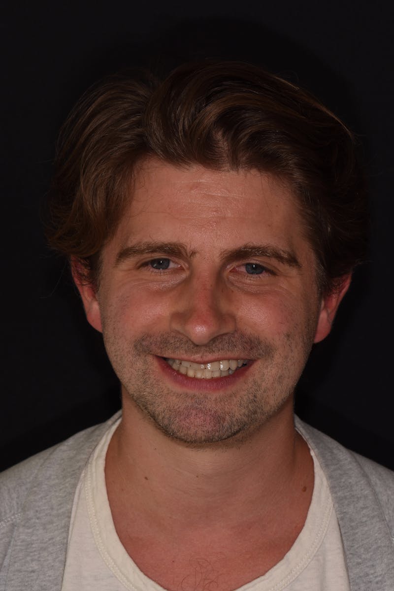 Patient Smile Before & After Gallery - Patient 366801 - Image 1