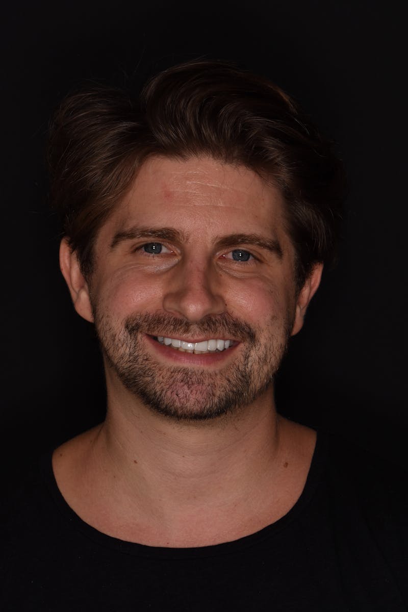 Patient Smile Before & After Gallery - Patient 366801 - Image 2