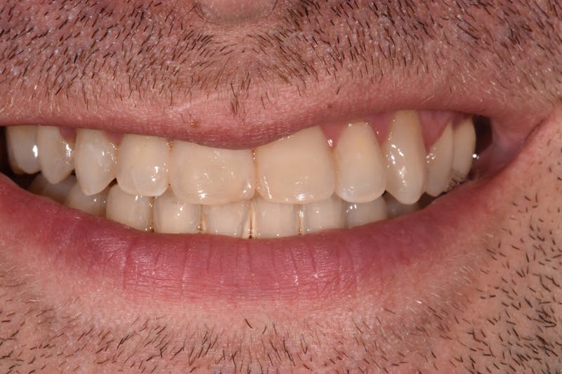 Patient Smile Before & After Gallery - Patient 366801 - Image 3