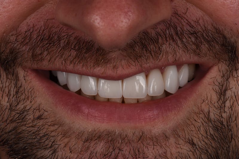 Patient Smile Before & After Gallery - Patient 366801 - Image 4