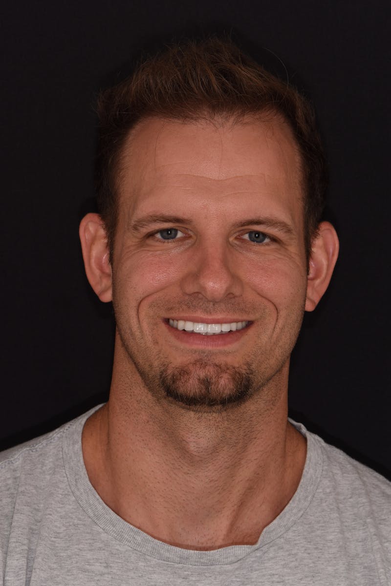 Patient Smile Before & After Gallery - Patient 953671 - Image 1